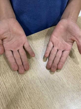 9歲小學(xué)生長(zhǎng)期拍煙卡，手部粗糙長(zhǎng)繭。受訪者供圖